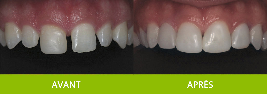 reconstruction de la dentition facettes composite